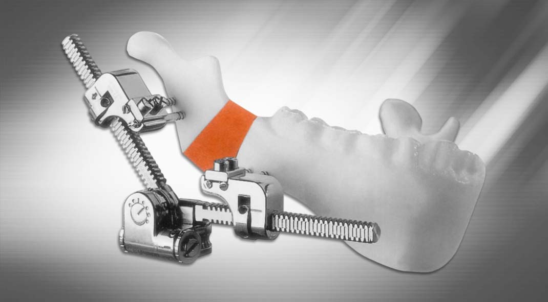 Multi-Guided Mandibular Distractor