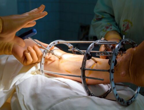 External Fixators India – Advanced Solutions for Bone Fracture Treatment