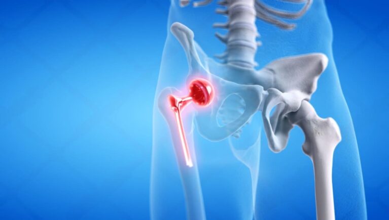 Best Hip Implants in Manufacturer and Exporter in India