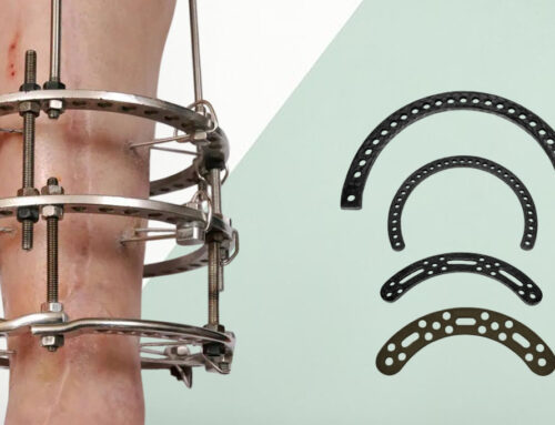 External Fixators – Quality Systems for Effective Bone Injury Treatment