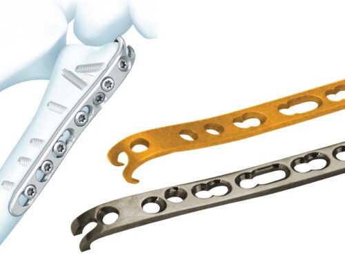 Ulna Plate – Types and Benefits