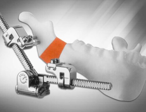 Multi-Guided Mandibular Distractor – Key Features and Benefits