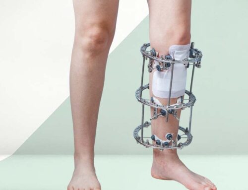 External Fixators India – Perfect Solution to External Bone Fractures