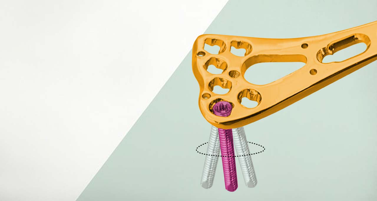 A Guide to Variable Angle Locking Plate Systems