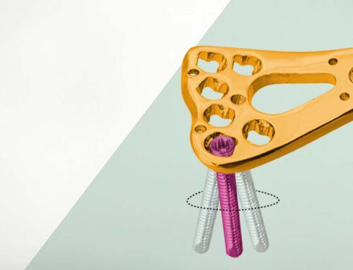 A Comprehensive Guide to Variable Angle Locking Plate Systems